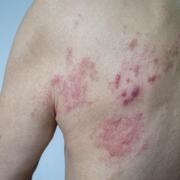 Shingles is caused by the same virus as chickenpox and can be brought on by things like stress.